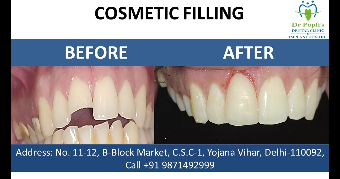 Cosmetic Filling