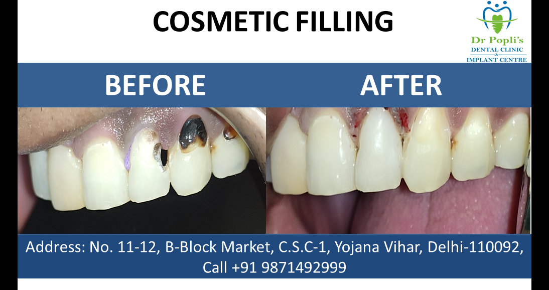 Cosmetic Filling