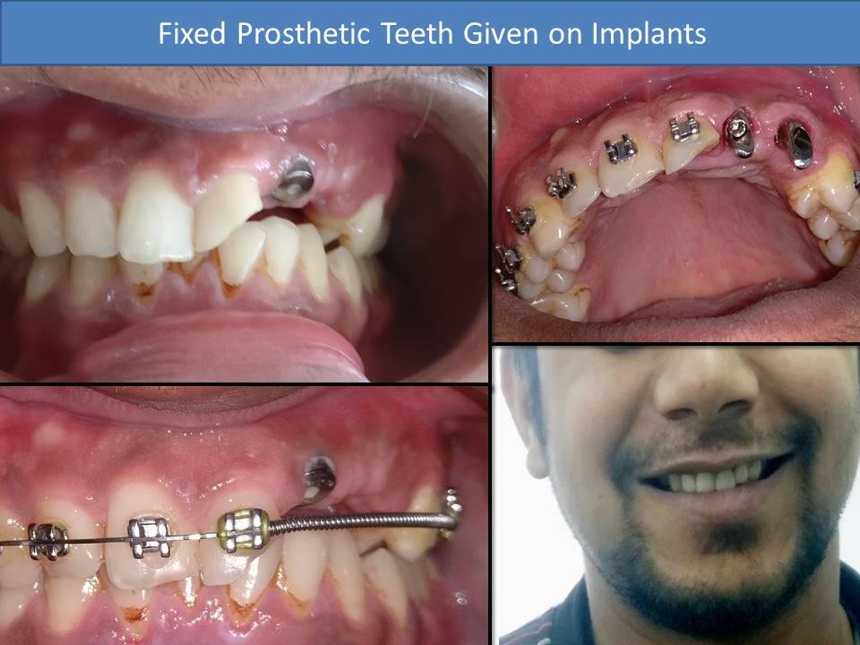 Implant Treatment