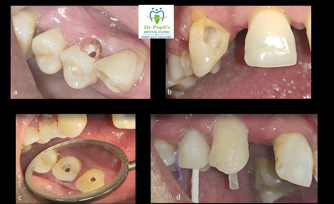 Saving hollow shell teeth