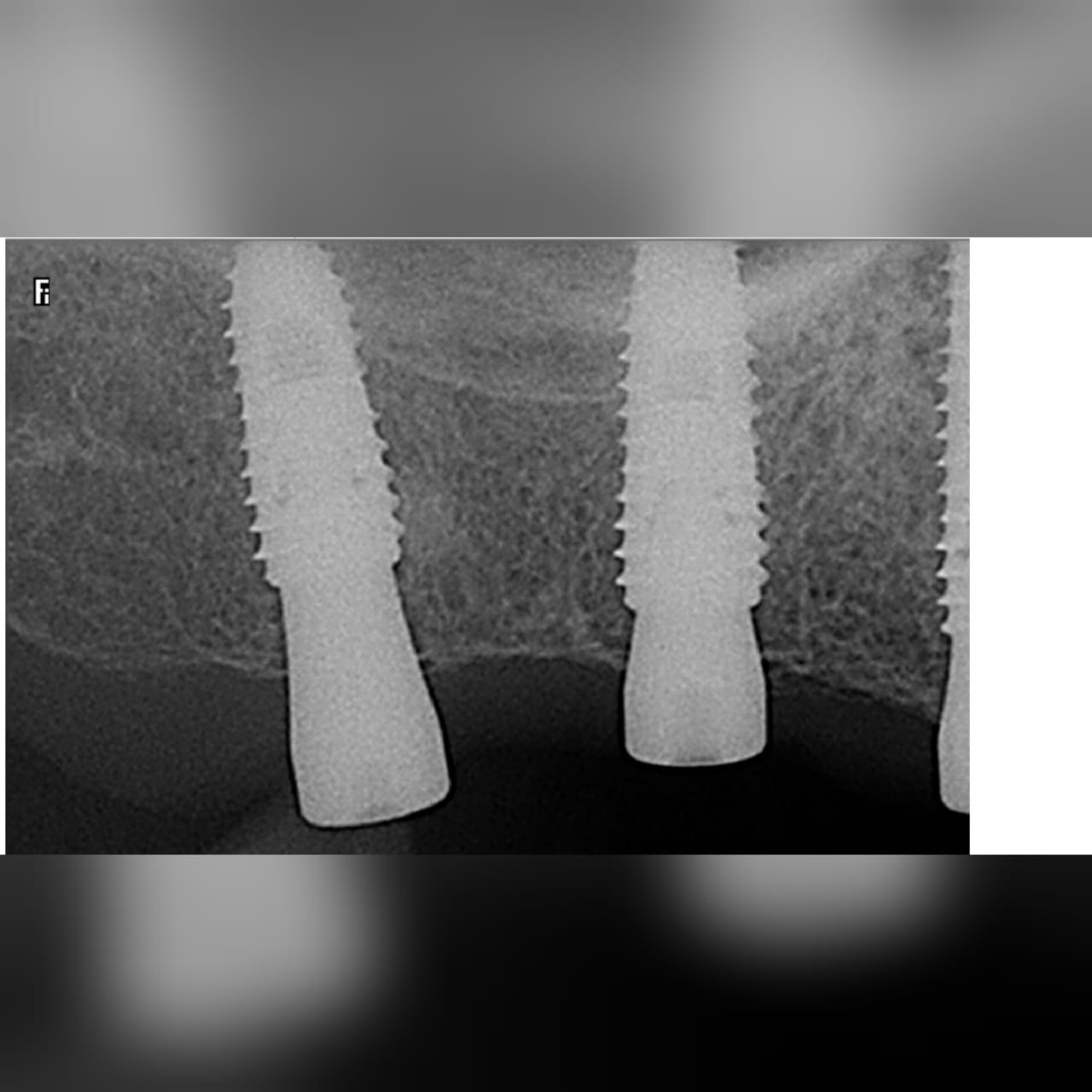 Direct and indirect sinus lift