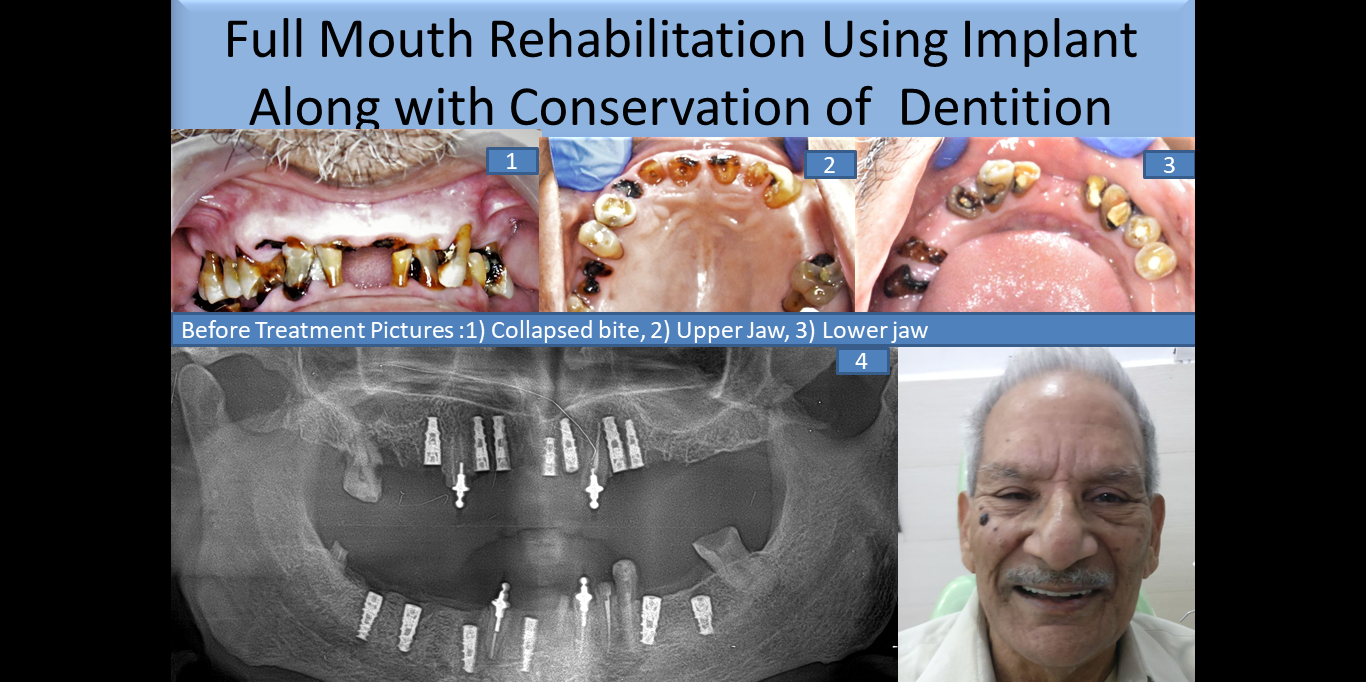 Full mouth implant placement