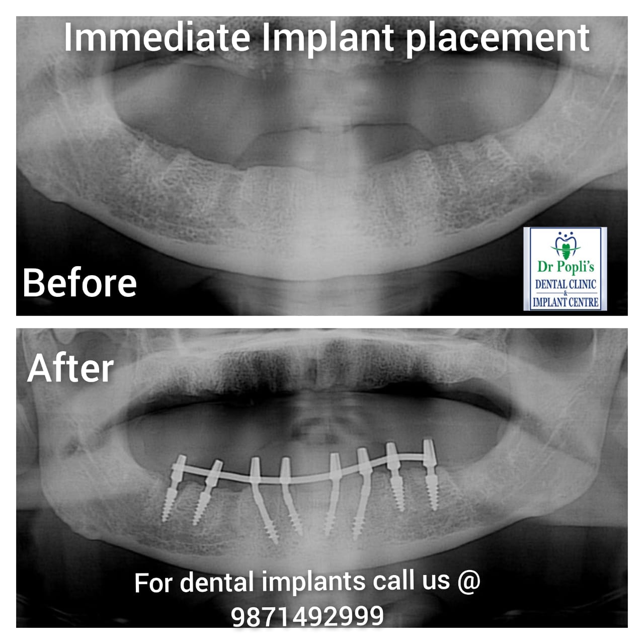Complete lower arch implant