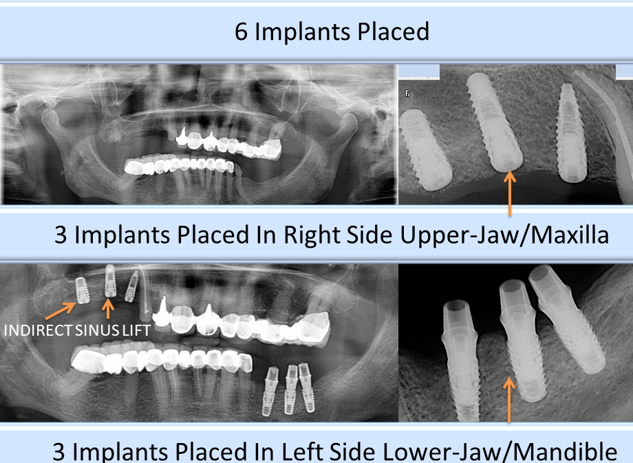 Partial and complete full arch implant