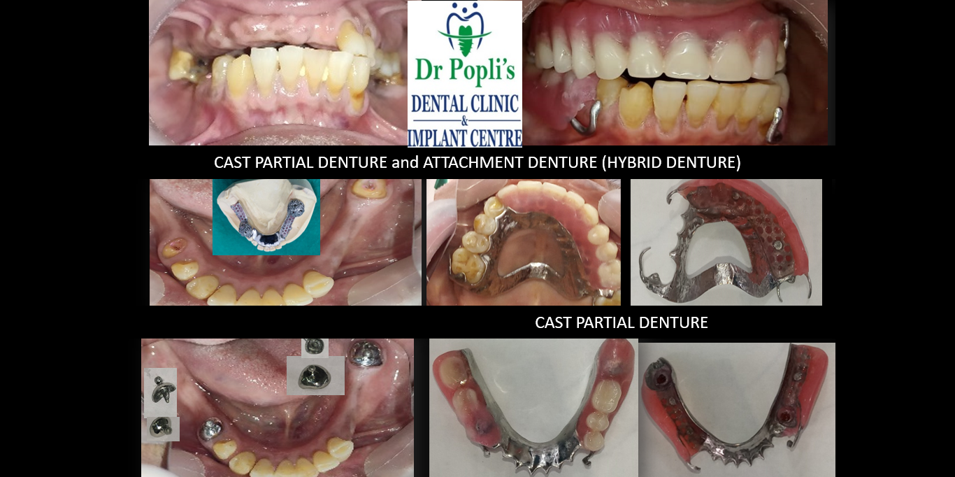 Cast partial dentures