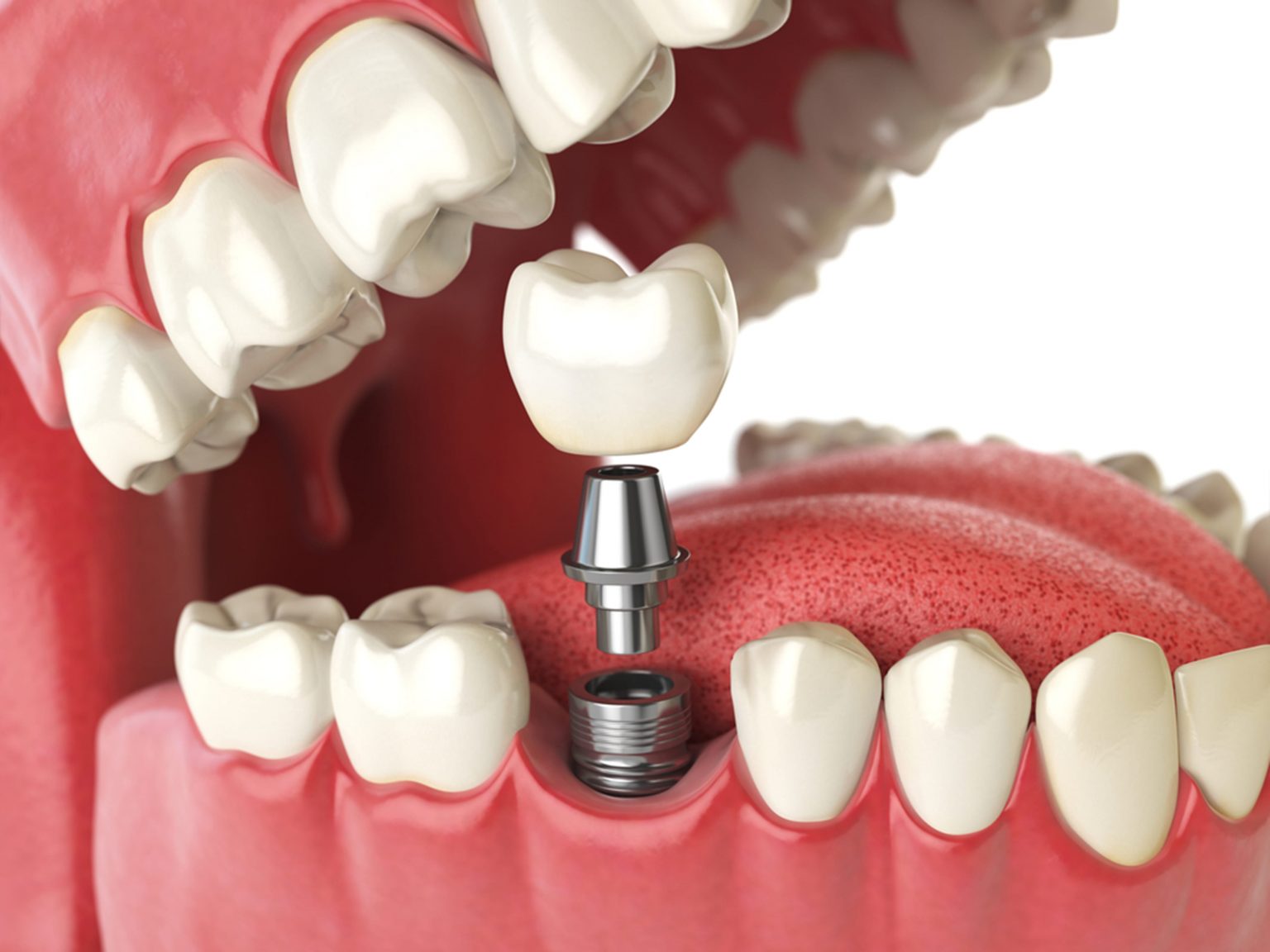 Dental Implants in Delhi