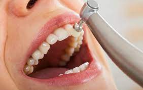 Professional Teeth Cleaning in Delhi