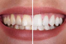 Teeth Whitening Treatment in Delhi