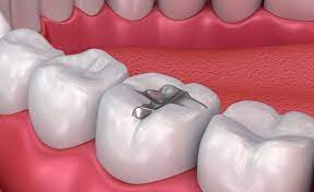 Silver Amalgam Restorations in Delhi