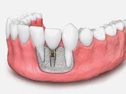 Single Sitting Implant Restoration in Delhi