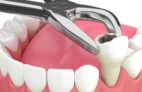 Painless Tooth Extraction in Delhi