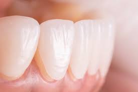 Dental Veneers Treatment in Delhi