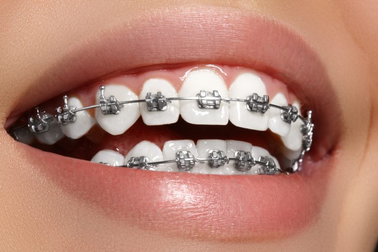 Orthodontic Treatment in Delhi