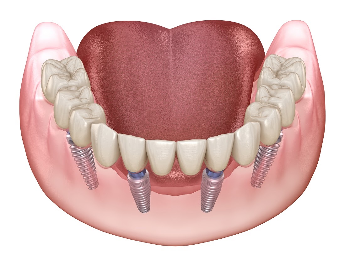 Full Mouth Implant Rehabilitation in Delhi