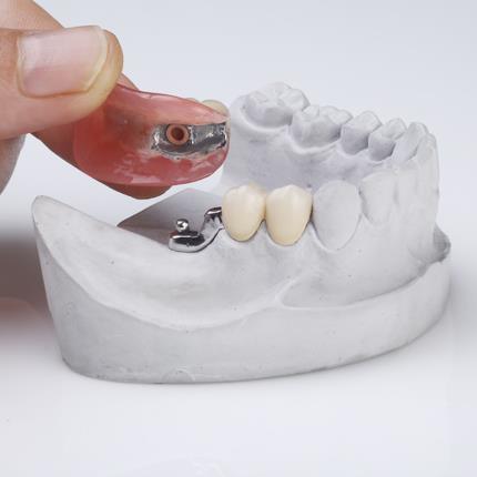 Attachment Dentures in Delhi